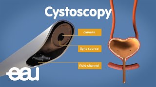 Cystoscopy overactive bladder [upl. by Enialed]