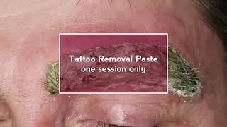 Eyebrow Tattoo Removal Procedure [upl. by Noffets]