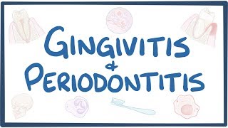 Gingivitis and periodontitis  causes symptoms diagnosis treatment pathology [upl. by Anileh275]