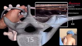 The ESP erector spinae plane Block  Our Current Understanding [upl. by Aselehc]