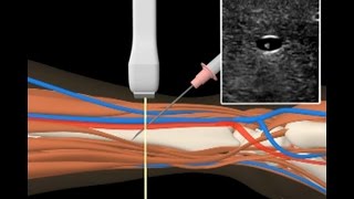 Anlage invasive arterielle Druckmessung [upl. by Hagep370]