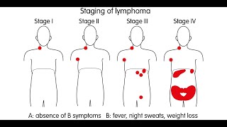 Treating BCell NonHodgkin Lymphoma [upl. by Jeffers130]