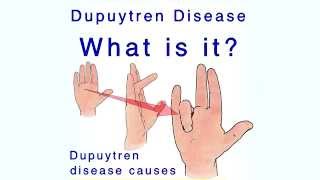 Treatment Options for Dupuytrens Contracture [upl. by Yssak]