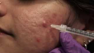 Watch amp Learn Intralesional injections [upl. by Paxon]