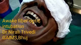 Awake fiberoptic intubationVideobronchoscope has been used [upl. by Pontius]