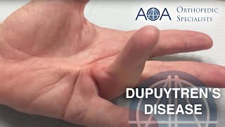 Anatomy  PALMAR APONEUROSIS  Dupuytrens contracture [upl. by Einahteb821]