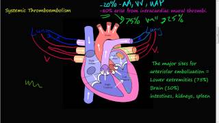 60P  Systemic Thromboembolism [upl. by Amling]