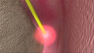 Laser Periodontal Therapy  WPT™ Animation [upl. by Analed679]