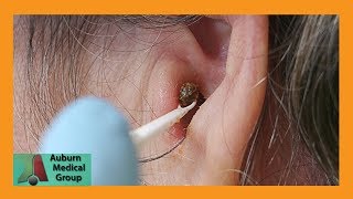 Chunky Earwax Removal  Auburn Medical Group [upl. by Hgieleak474]