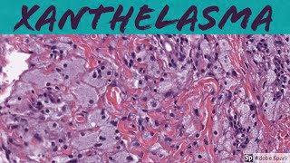 Xanthelasma Xanthoma of Eyelid 5Minute Pathology Pearls [upl. by Adrienne485]