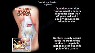 Quadriceps Tendon Rupture  Everything You Need To Know  Dr Nabil Ebraheim [upl. by Krueger]