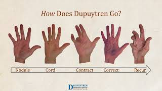 Dupuytren Awareness [upl. by Yllod]