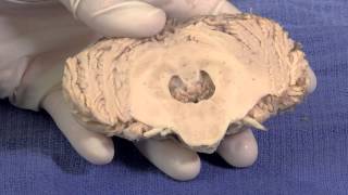 The Cerebellum Neuroanatomy Video Lab  Brain Dissections [upl. by Idieh]