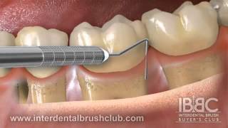 Periodontal disease causes and treatment [upl. by Nyl981]