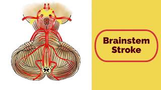 Brainstem Stroke Syndromes [upl. by Eirelam]