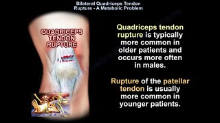 Bilateral Quadriceps Tendon Rupture  Everything You Need To Know  Dr Nabil Ebraheim [upl. by Aserehs522]