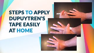 Dupuytrens Contracture Treatment  Everything You Need to Know [upl. by Alel643]